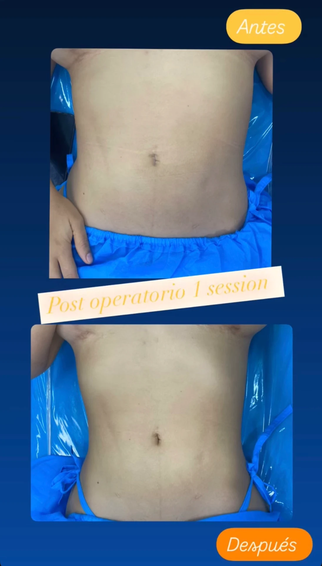 Antes y después: Postoperatorio corporal